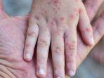Ilustrasi-penyakit-Mpox.jpg