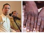 Kolase-Foto-Pj-Gubernur-DKI-Heru-Budi-Hartono-dan-ilustrasi-cacar-monyet.jpg