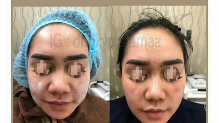 Ingin Meniruskan Wajah? Ini Alternatif yang Bisa Anda Pilih