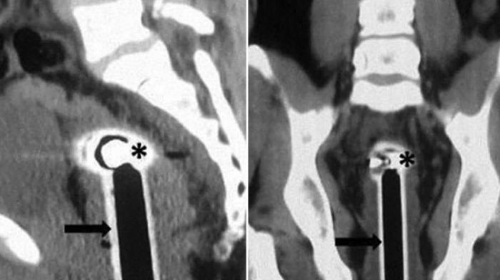 Kok Bisa Kepala Selang Air Masuk ke Tubuh Pria India Ini