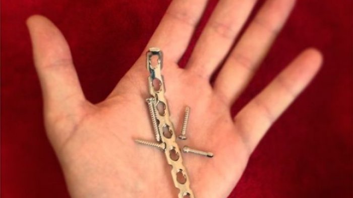 FOTO: Pria ini Buat Cincin dari Bekas Logam Pen Tubuhnya, Hasilnya Keren