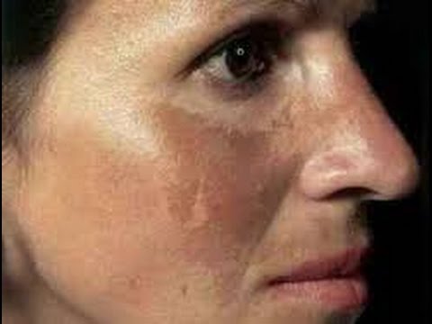 Ramuan Sederhana Singkirkan Flek Hitam di Wajah dengan Cepat