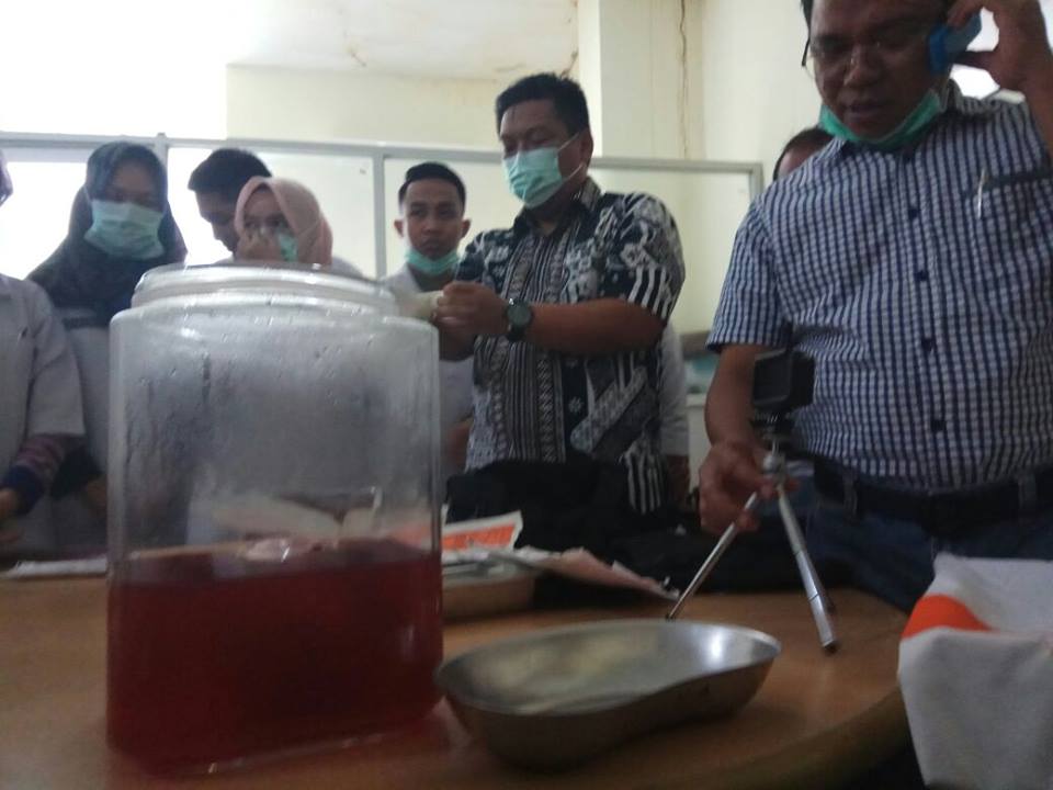 Peristiwa Langka, Bayi Membatu Selama 37 Tahun Diangkat dari Rahim Sang Ibu di RS Raden Mattaher