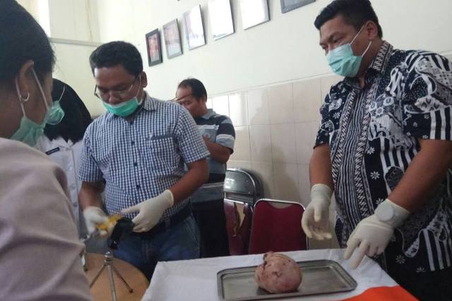 GALERI FOTO: Ini Penampakan Bayi Membatu yang Diangkat setelah 37 Tahun di Perut Ibunya