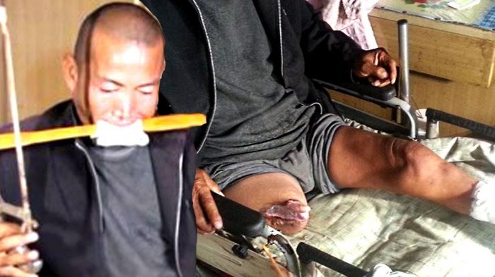 Demi Bertahan Hidup, 5 Orang Ini Lakukan 'Operasi' Sendiri, Mulai Amputasi Hingga Batu Kandung Kemih