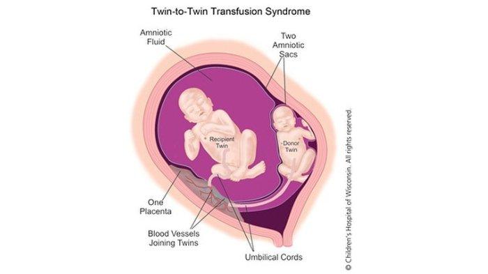 Calon Bayi Ammar Zoni & Irish Bella Meninggal Karena TTTS Mengenal Twin to Twin Transfusion Syndrome