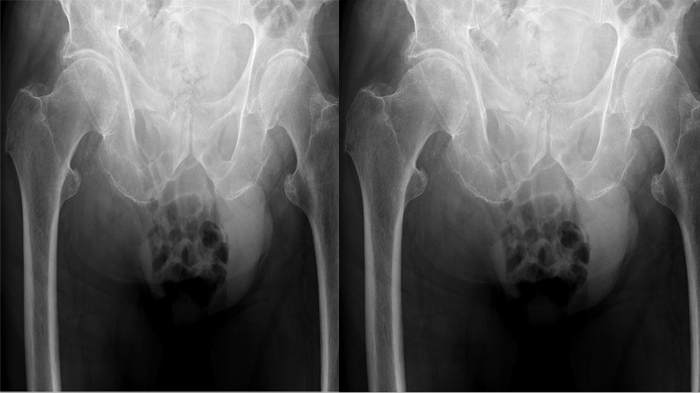 Awalnya Demam dan Gatal di Selangkangan, 3 Bulan Kemudian Buah Zakarnya Bengkak Sebesar Biji Kelapa