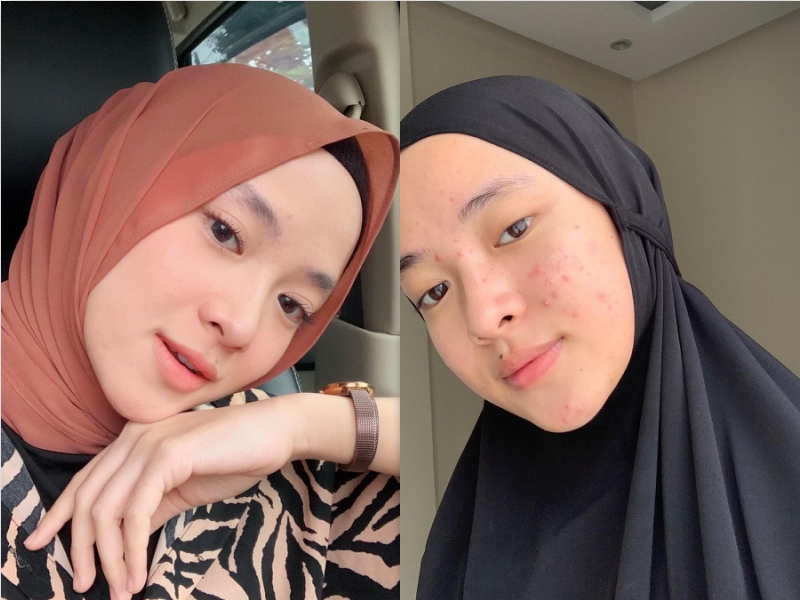 Wajah Nissa Sabyan Terlihat Iritasi dan Berjerawat, Iis Dahlia Sampai Khawatir, Tapi Dicuekin!