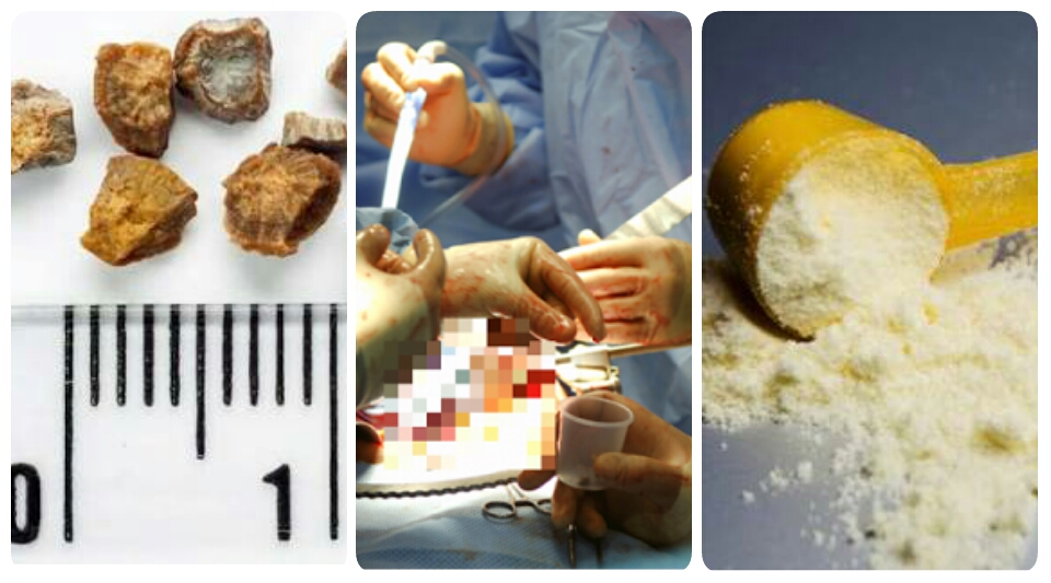 LIMA Gejala Batu Ginjal Harus Diketahui, Termasuk Kencing Tidal Lancar: Jangan Sepelekan Gejala No 1