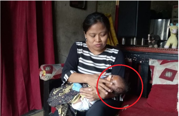 DERITA Bayi 40 Hari Masih Dibedong Digigit Tikus, Wajahnya Penuh Darah, Hidung Dijahit Karena Sobek