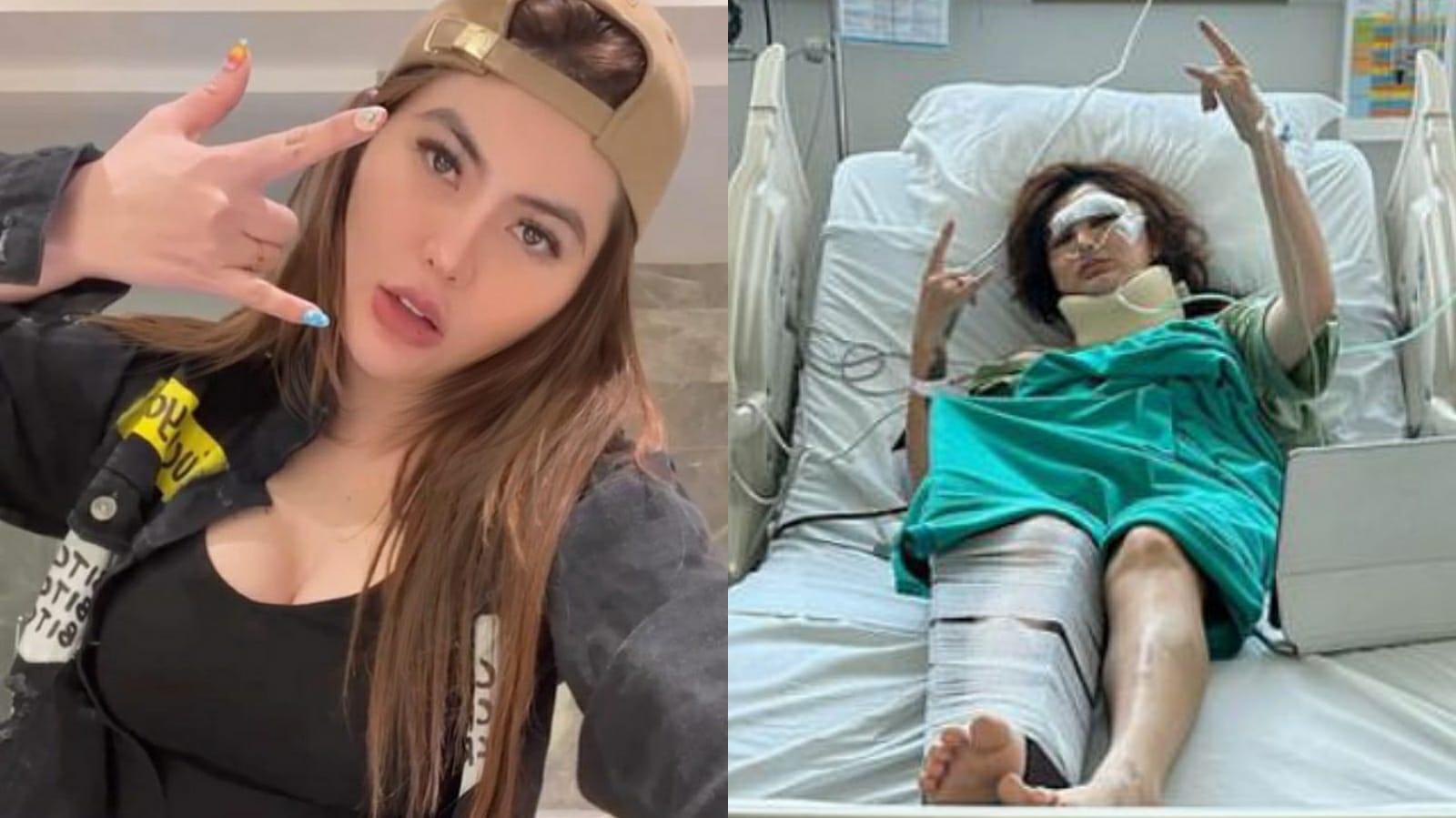 Kondisi Angela Lee 'Barbie Jowo' Usai Alami Kecelakaan Mobil, Wajah Luka dan Kaki Dipasang Pen