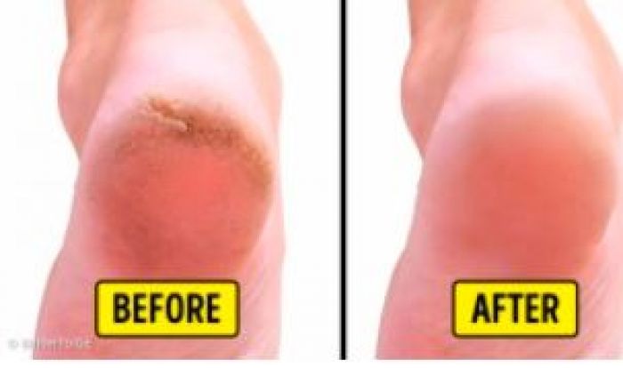 bahan-untuk-menghaluskan-tumit-yang-pecah-pecah-bright-side_20180216_125011.jpg