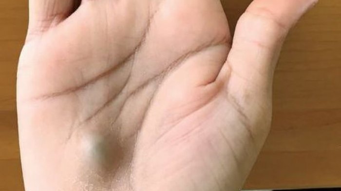 Pernah Rasakan Benjolan Berdenyut Muncul di Tangan Seperti Pria Ini. Ternyata Ini yang Dideritanya