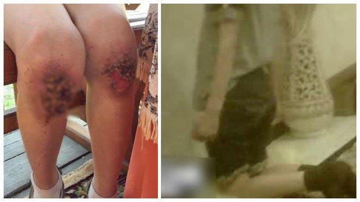 Mengerikan, Akar Muncul Dilutut Anak Ini Karena Sering Dihukum 9 Jam Berlutut di Atas Biji-bijian