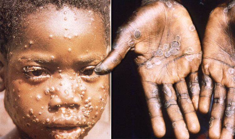 Apa Itu Cacar Monyet Monkeypox, Gejala dan Penularannya? 23 Orang di Singapura Terpaksa Dikarantina