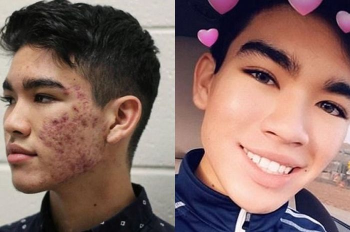 Alami Jerawatan yang Parah, David Justru Bisa Bersihkan Wajahnya dengan Cara Sederhana
