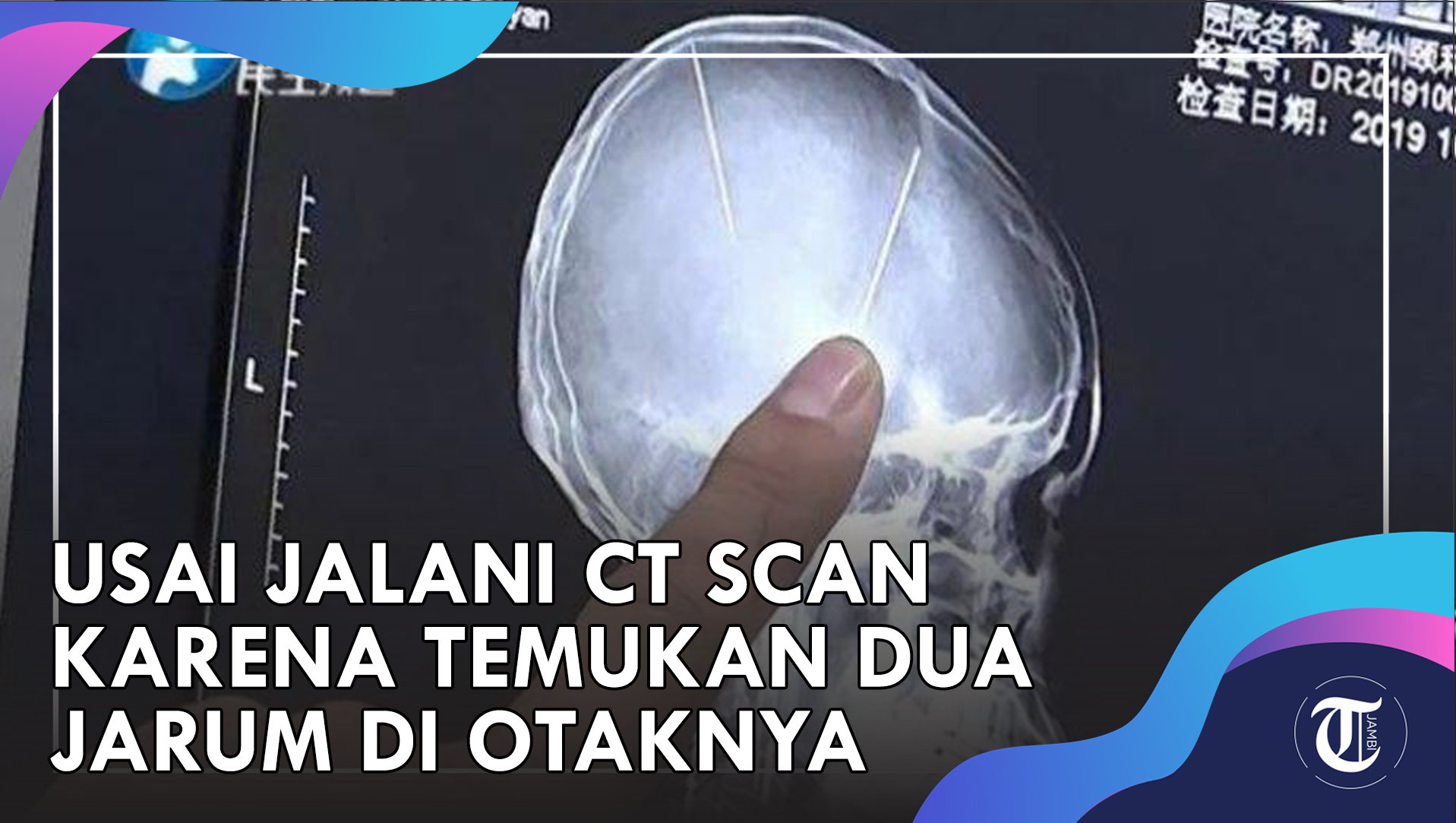 VIDEO: Ada Dua Jarum di Otak Wanita Ini, Bertahun-tahun Tanpa Keluhan, Kecelakaan Ungkap Fakta Aneh