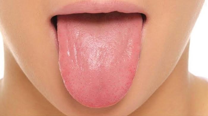 Dokter Temukan Gejala Baru Covid-19 Bernama Covid Tongue, Waspada Jika Lidah Anda Berubah Warna
