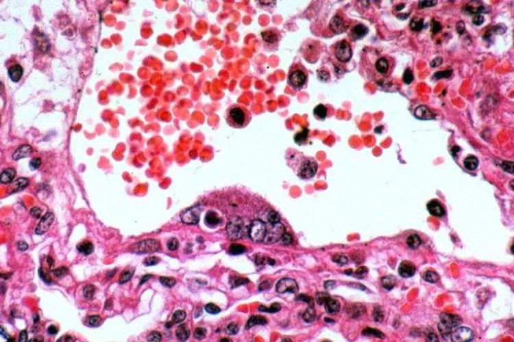 Nipah, Virus Mematikan Yang Belum Ada Obatnya Menyerang India, Begini Cara Penyebarannya