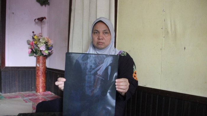 VIDEO: Pemuda Ini Jalani 3x Operasi Untuk Keluarkan Sendok, Pisau dan Benda Lainnya dari Perutnya