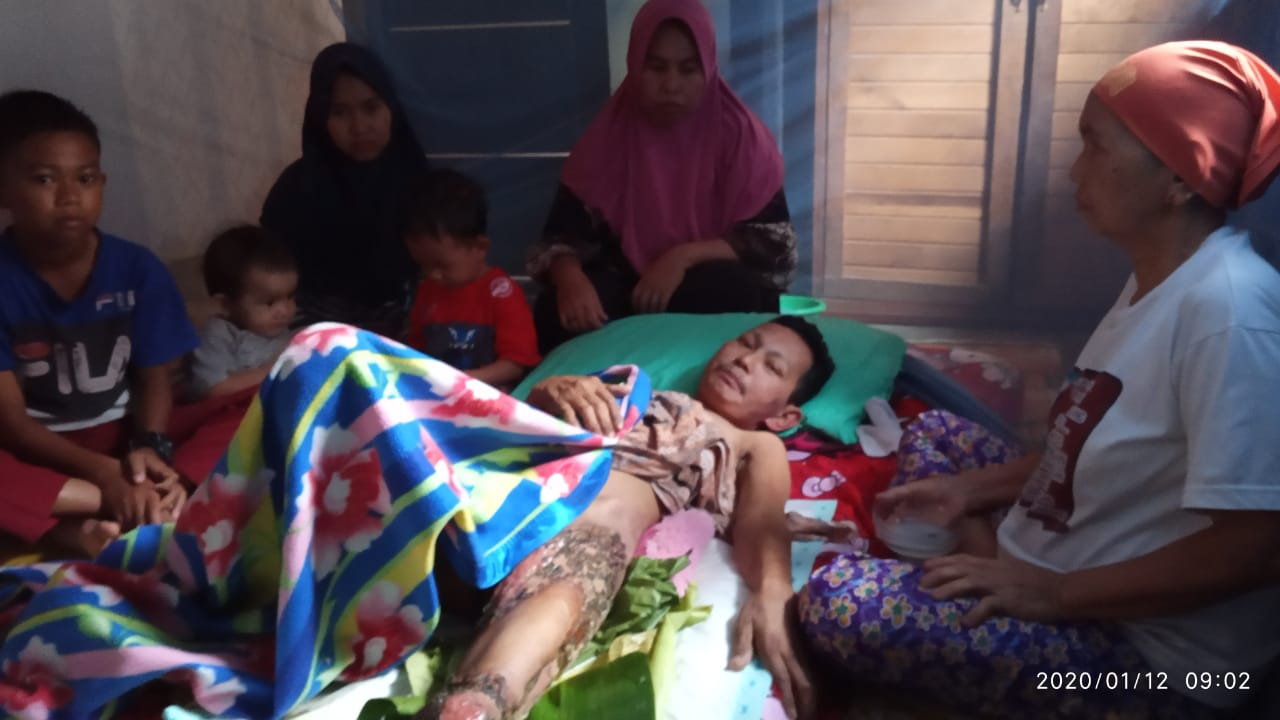 Kulitnya Seperti Terbakar, Abdul Mutholib Warga Sekernan, Muarojambi Idap Penyakit Aneh