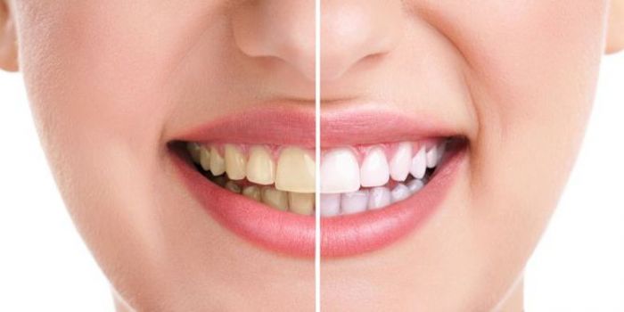 Gigi Putih dan Cemerlang dengan 8 Tips Mudah, Tak Perlu Biaya Mahal, No 7 Cuma Dioles