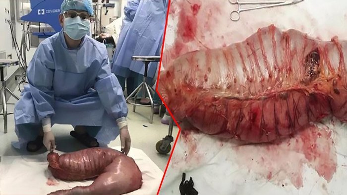 Mengerikan, Gara-gara Ususnya Rusak, Tubuh Perempuan Ini Nyaris Dipenuhi Kotorannya Sendiri