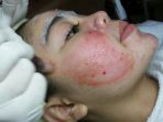 16022018_perawatan-kecantikan-di-zee-skincare_20180216_230544.jpg