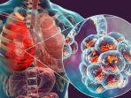 Ilustrasi-paru-paru-yang-mengalami-pneumoniae.jpg