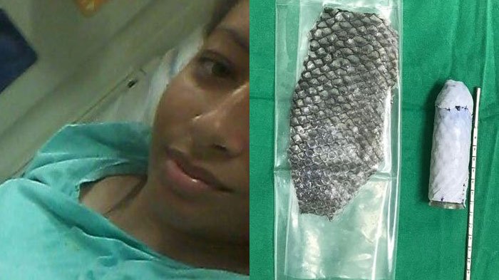 Lahir Tanpa Organ Intim, Wanita Ini Jalani Operasi Pakai Kulit Ikan Nila, Hidupnya Seketika Berubah!