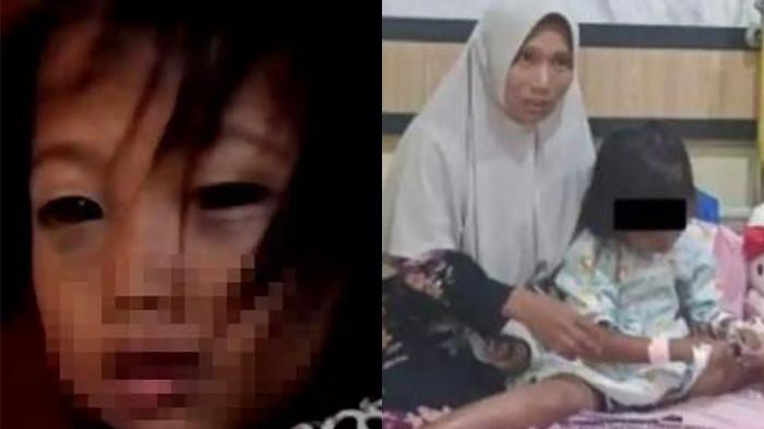 TERNYATA BUKAN DIANIAYA - Siswi SD di Palembang berinisial F viral setelah matanya dalam kondisi memerah dan lebam sepulang sekolah. Kini terungkap ia tidak mengalami kekerasan tetapi mengidap pertusis.