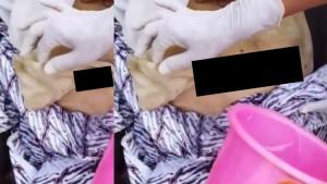 Viral-sebuah-video-yang-menunjukkan-operasi-tanpa-dijahit.jpg