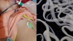 cacing-di-tubuh-Balita-Bengkulu-viral-apa-penyebabnya.jpg