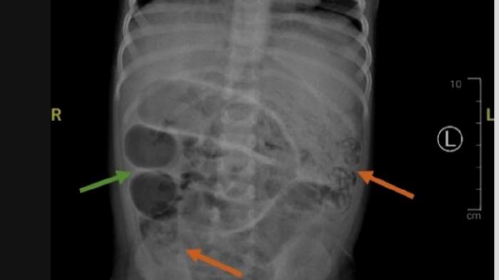 Pantas Anak 3 Tahun di Jember Tak Bisa BAB, 4 Dokter Keluarkan Gumpalan Cacing, Bukan Cacing Pita