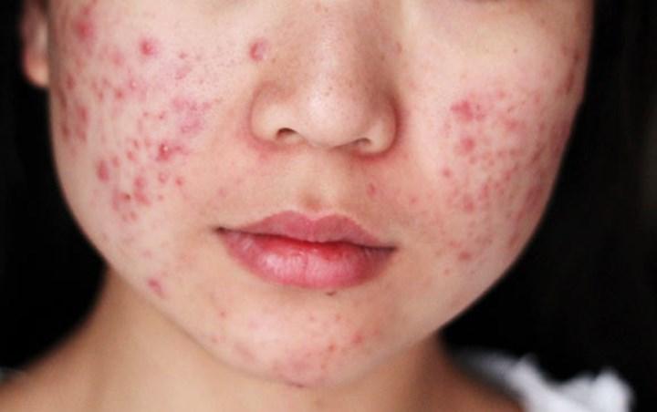 Ilustrasi-wajah-berjerawat-dalam-artikel-arti-kata-breakout.jpg