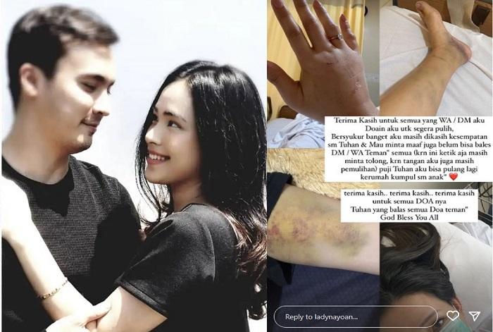 Lady-Nayoan-membagikan-foto-foto-bagian-tubuhnya-yang-tampak-memar.jpg