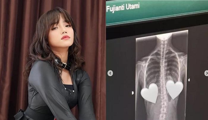 Skoliosis-yang-diderita-Fuji-merupakan-kelainan-pada-tulang-belakang.jpg