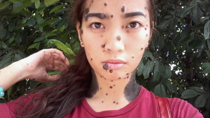 Ingat Gadis yang Dibully Gara-Gara Tahi Lalat di Sekujur Tubuhnya? Begini Penampilannya Sekarang