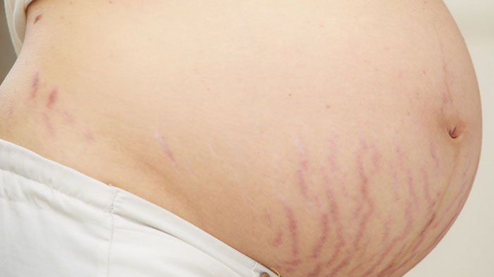 Punya Stretch Marks Setelah Melahirkan? Lakukan 4 Perawatan Rumahan Berikut untuk Menghilangkannya
