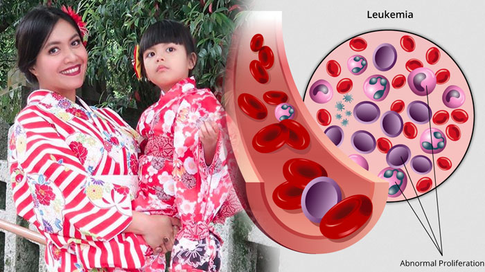 5 Hal Tentang Leukemia pada Anak yang Perlu Diketahui, Penyakit yang Diderita Putri Tunggal Denada