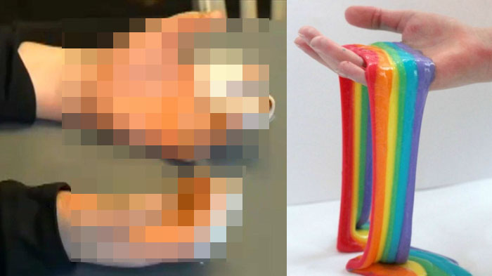 Mengerikan, Lihat yang Terjadi Pada Tangan Bocah 11 Tahun Ini Saat Bikin Slime, Perhatikan Anak Anda