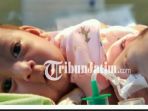 berita-surabaya-bayi-kembar-siam-asal-ternate_20180428_111515.jpg