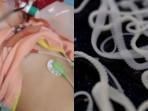 Penyebab Gumpalan Cacing Bersarang di Tubuh Kakak-Adik Bengkulu, Pihak RSUD: Kuku Tangannya Kotor
