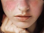 ilustrasi-penyakit-lupus_20170916_104406.jpg