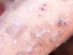 ilustrasi-penyakit-scabies.jpg