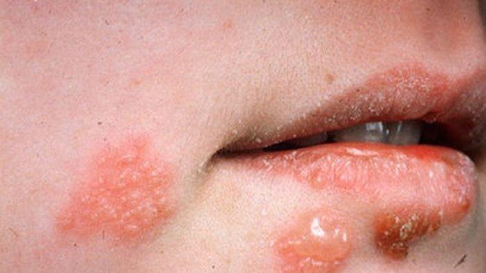 Herpes Simpleks: Cara Pencegahan Sehari-hari untuk Mengurangi Risiko Penularan
