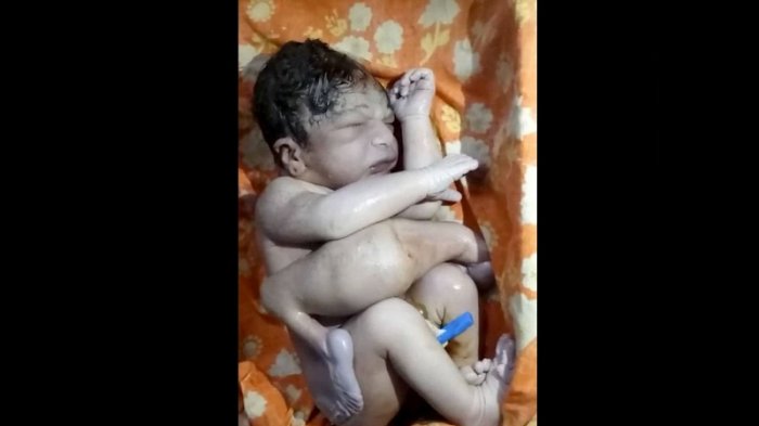 Miliki 4 Kaki dan 2 Kelamin, Bayi Kembar Parasit Ini Nyaris Dibuang Warga
