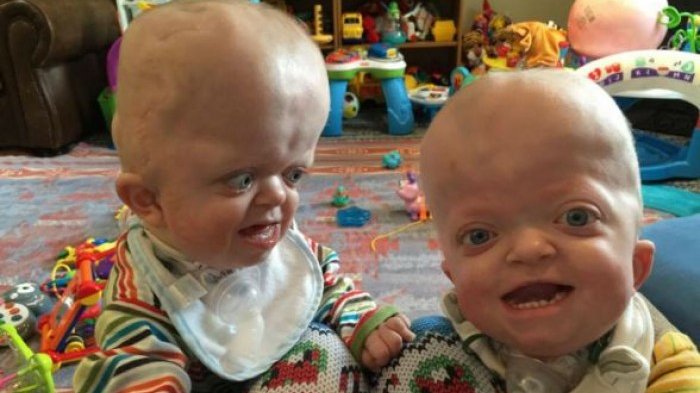 Bayi Kembar yang Punya Kelainan Kepala Membesar Beruntung Bertemu Wanita Mulia