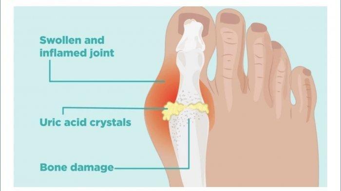Cara Redakan Asam Urat dengan Bahan-bahan Alami yang Tersedia di Dapur