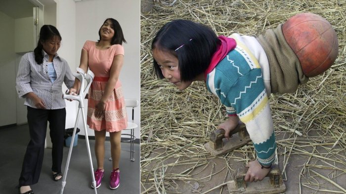 INSPIRATIF! Kisah Perjuangan Hidup Gadis 'Berkaki Bola Basket' yang Menjelma Menjadi Juara Renang!